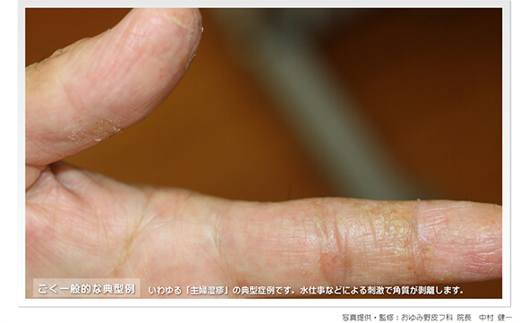 主婦湿疹（手湿疹）（症例写真）