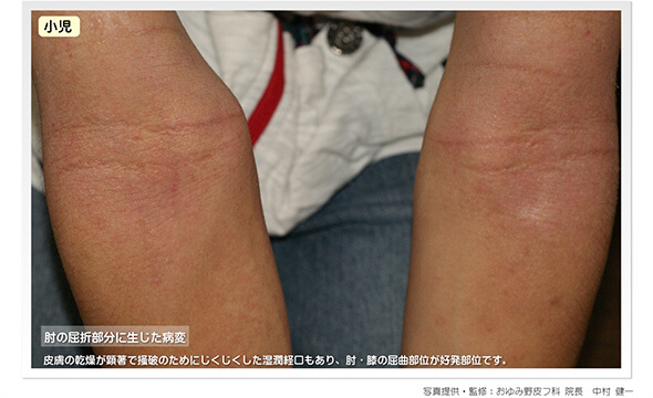アトピー性皮膚炎：肘の屈折部分に生じる病変（症例写真）