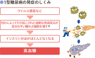 I型糖尿病