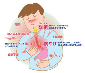 逆流性食道炎