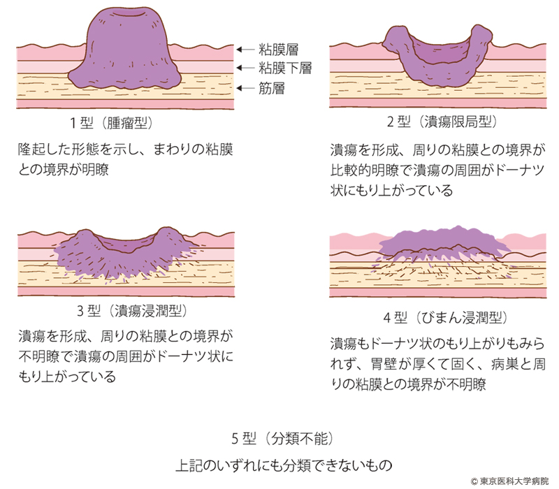胃がん