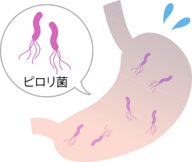 胃がん