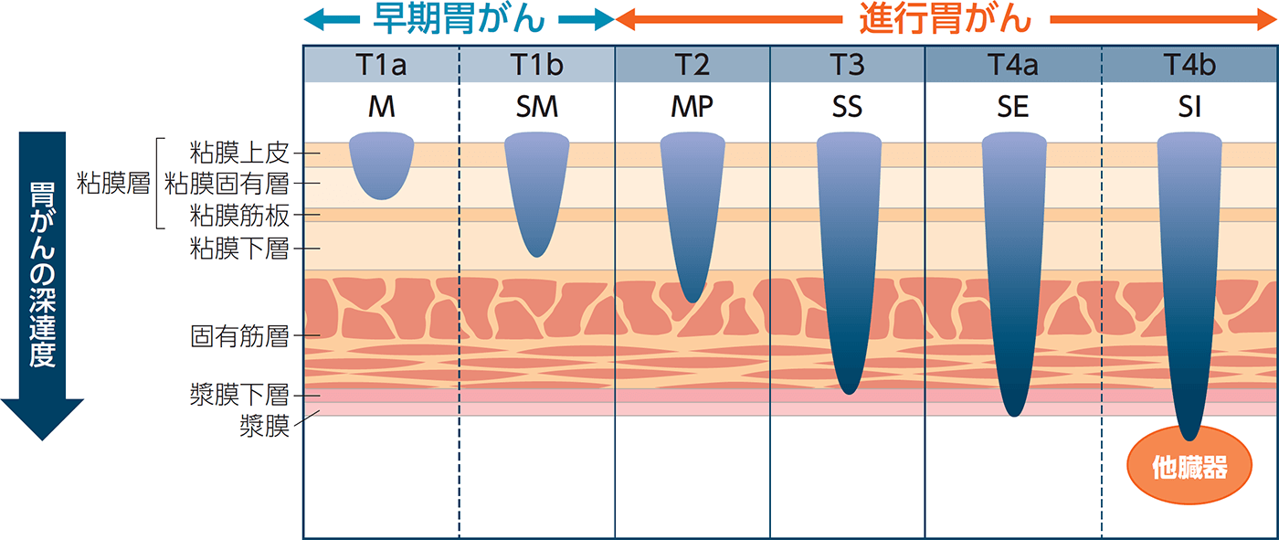 胃がん